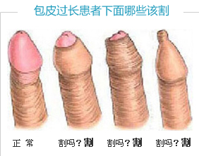 怎么才算是包皮过长